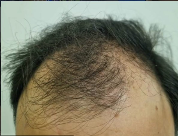 Recuperación frontal antes