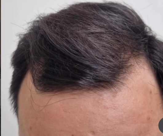 Recuperación frontal después